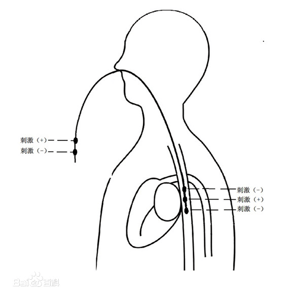 标准的valsalva动作,也被称为瓦氏试验,因为其简单无创,广泛用于室上