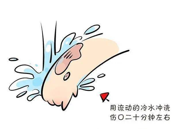烧伤怎么处理好得快呀 49f57a6610a84b3eaf979e6f03c7c716.jpeg