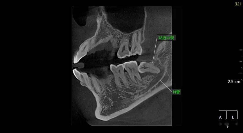 胡xx 20210306 智齿cbct 137xxxx0605