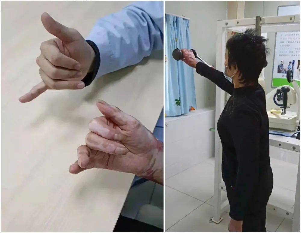 家为灯塔手烧伤患者康复之路