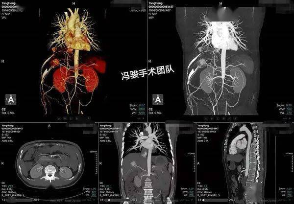 冯骏手术团队leriche综合征近肾主髂动脉长段闭塞腔内介入治疗