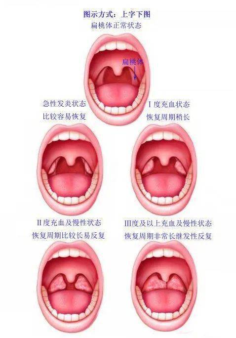 正常喉咙图片对比图片