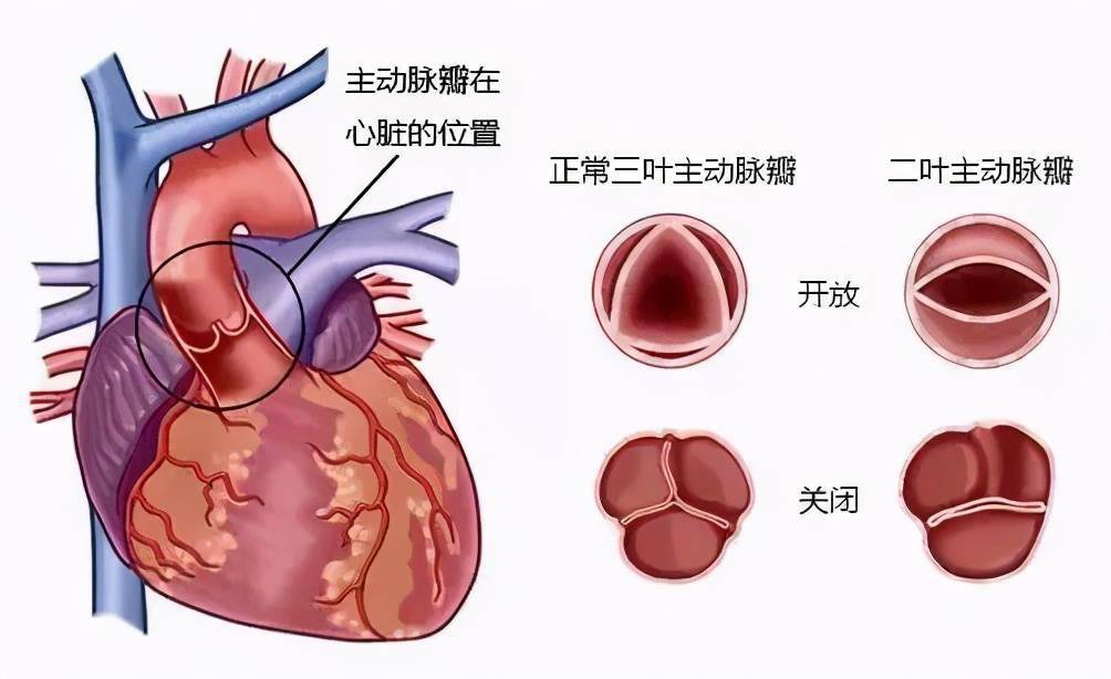 但是他治疗的是因心脏瓣膜钙化引起主动脉重度关闭不全的心脏瓣膜病