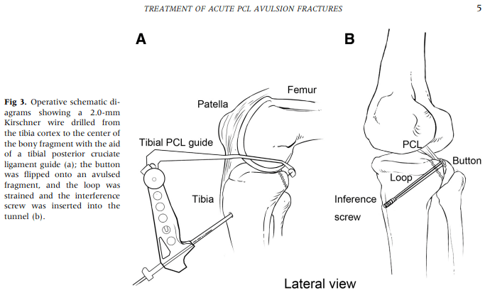 posterior cruciate ligament avulsion fractures with suspensory