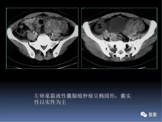 5大卵巢恶性肿瘤如何在ct上寻找蛛丝马迹医学影像经典ppt