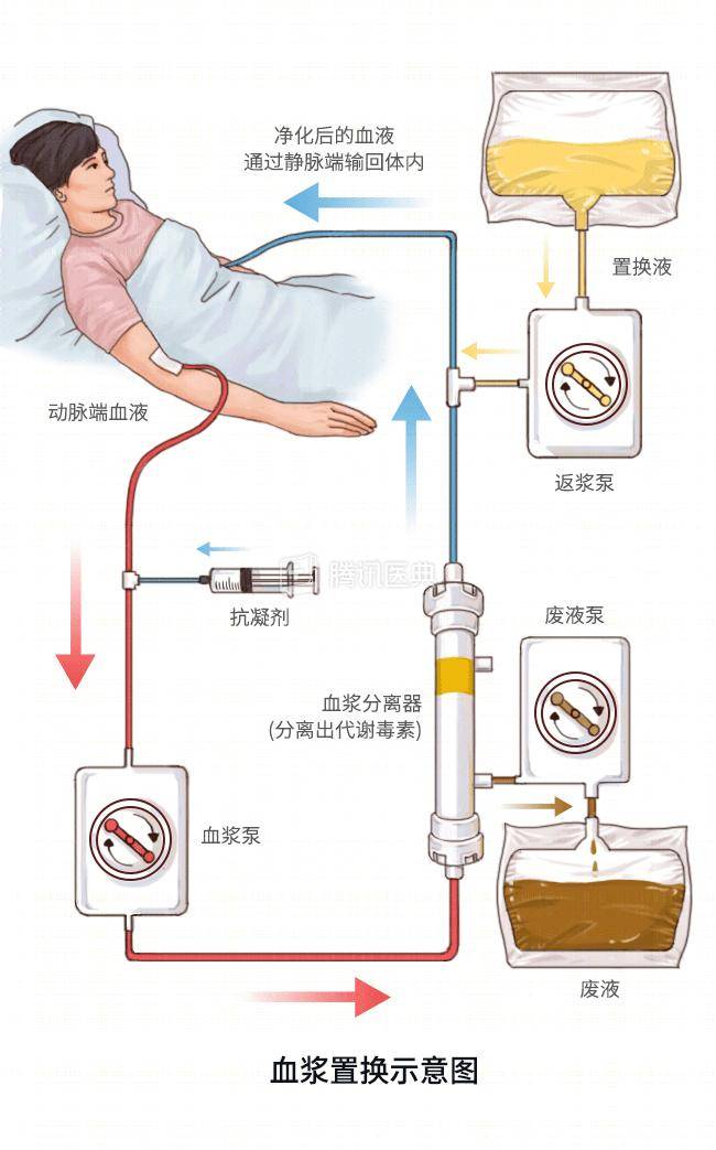 血液透析滤过原理图图片