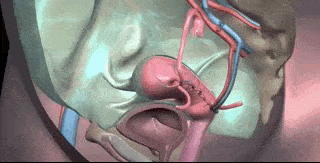 变性手术 演示动画图片