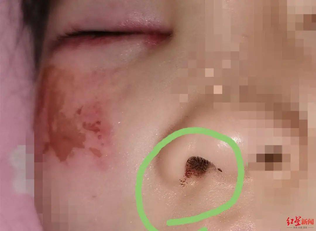 领导,"校方表示先带孩子看医生,其他的没说";"6号时,孩子说她眼睛模糊