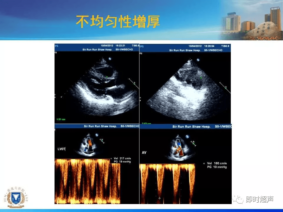 左室肥厚的超声心动图诊断思路