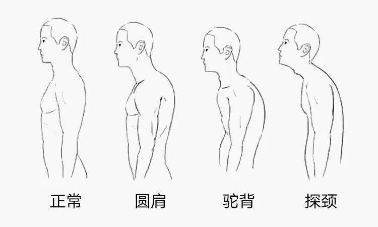 彎腰駝背羅圈腿孩子體態千萬別忽視