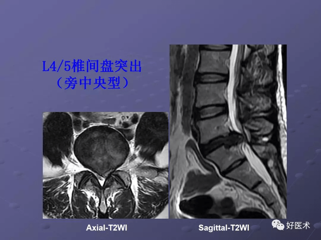 詳解脊柱常見疾病的mri診斷技巧值得學習借鑑