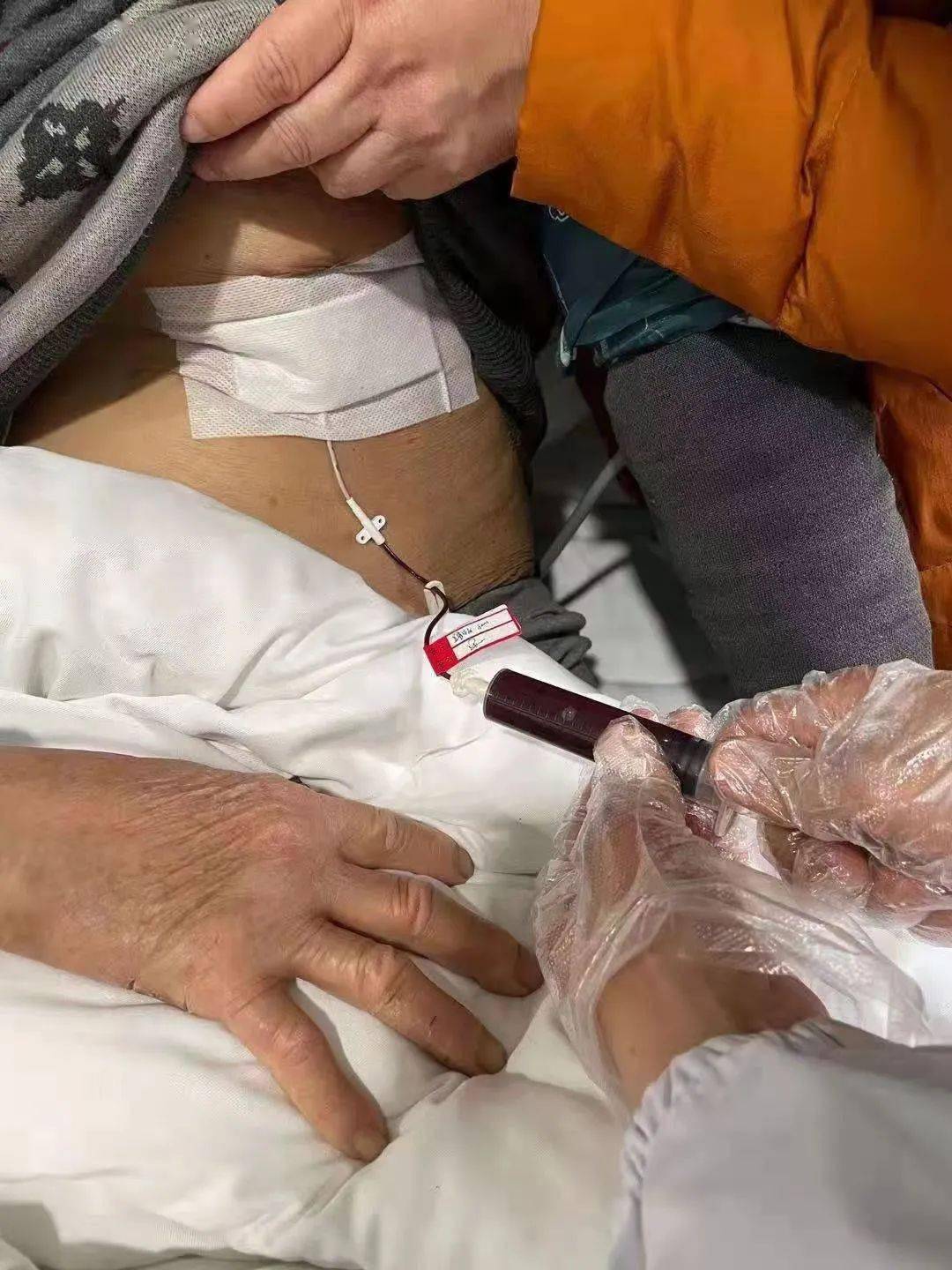 针尖上的艺术丨我院内科完成一例超声引导下心包积液穿刺置管引流术