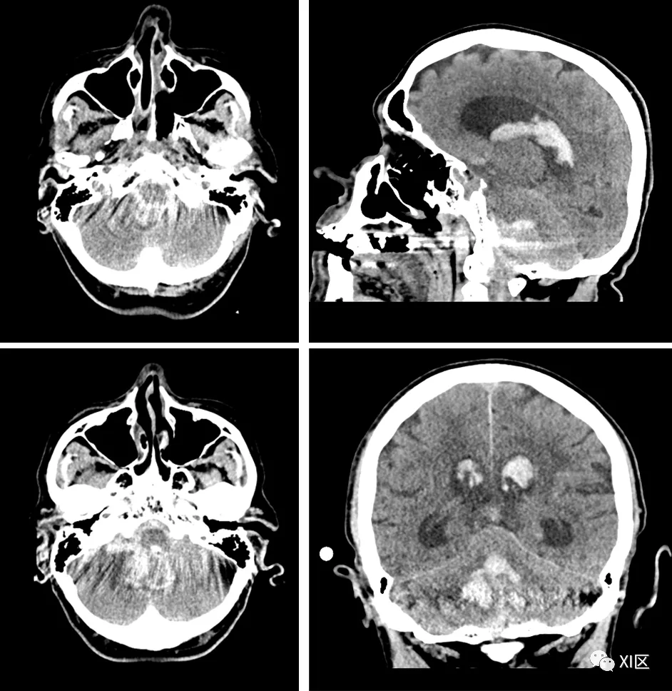 杯状伪影,右侧为校正后图像由于现代扫描仪内置了简单的线束硬化校正