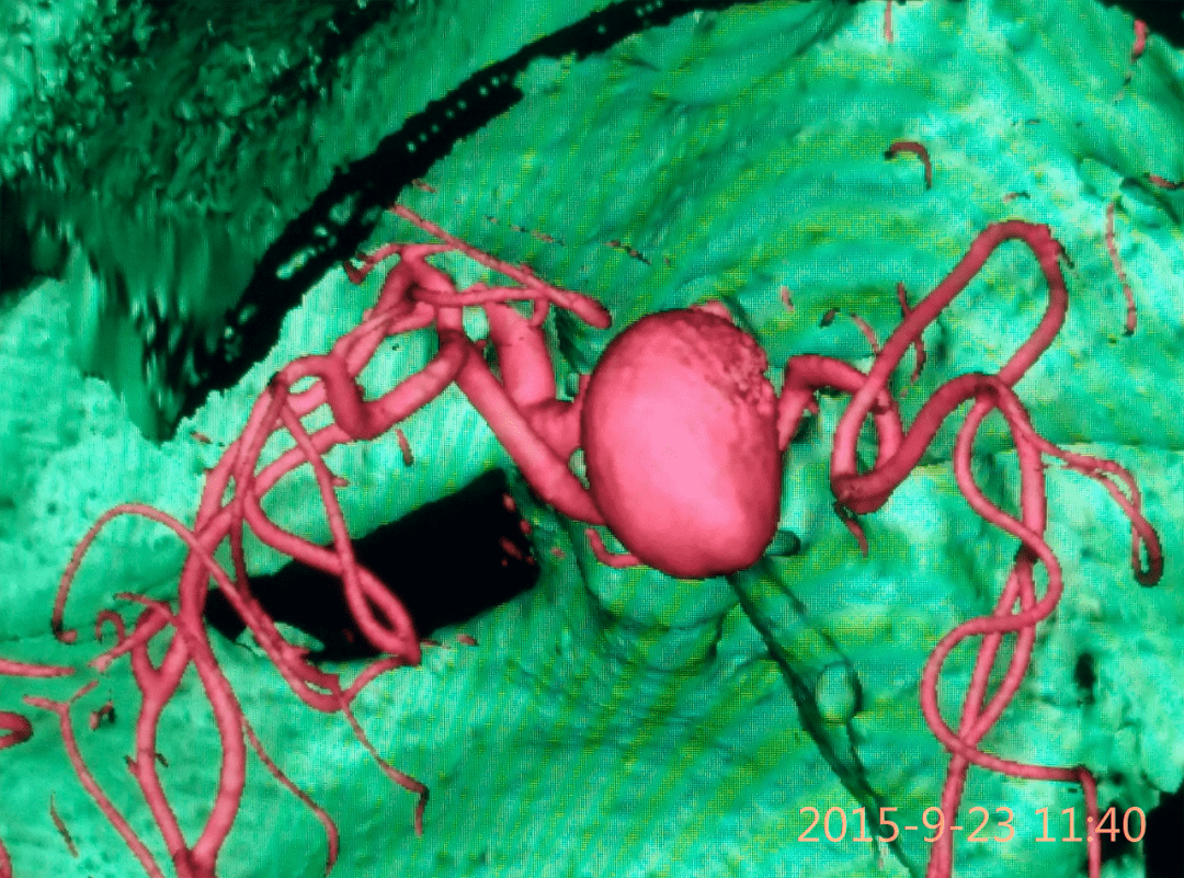 日本杉田动脉瘤夹图片