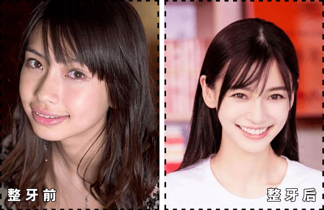 90%的明星都在戴的隐形牙套,能让你的颜值翻几倍