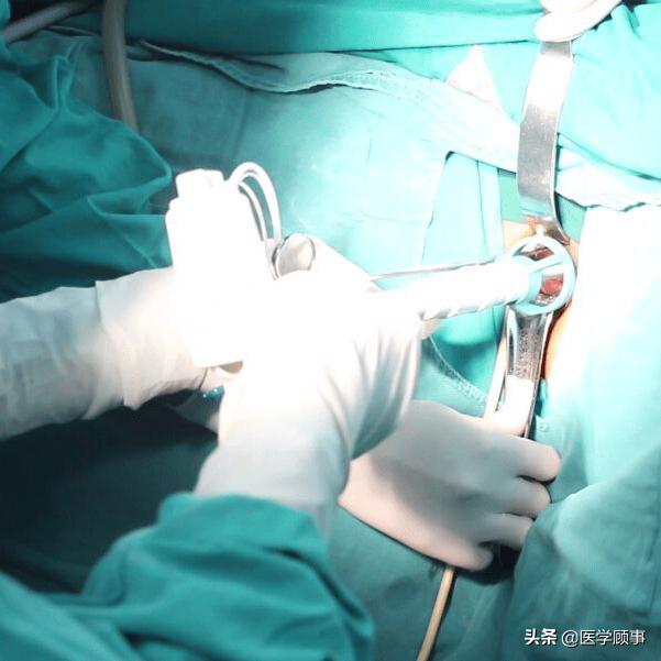 如做腹腔镜全子宫切除术,需在切除子宫前将阴道封堵球囊注入30~90ml