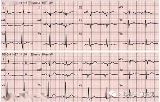 因病情加重,可因肺氣腫,心臟位置變化,使下壁導聯r波減小甚至呈qs型