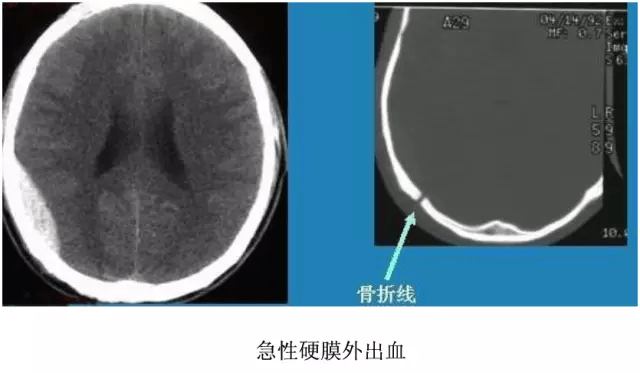 头颅骨ct图片