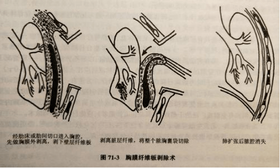 医文医话医院成功开展胸腔镜下胸膜剥脱手术