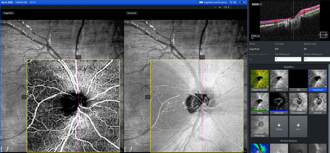每周最佳病例分享 | 玩转idi——抽丝剥茧_视盘