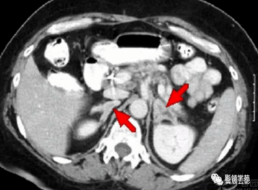 肾上腺增粗图片