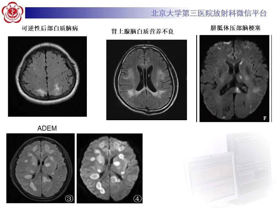 可逆性胼胝体压部病变综合征resles