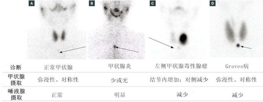 tsh,t3/t4,超聲……這麼多甲狀腺檢查怎麼選?