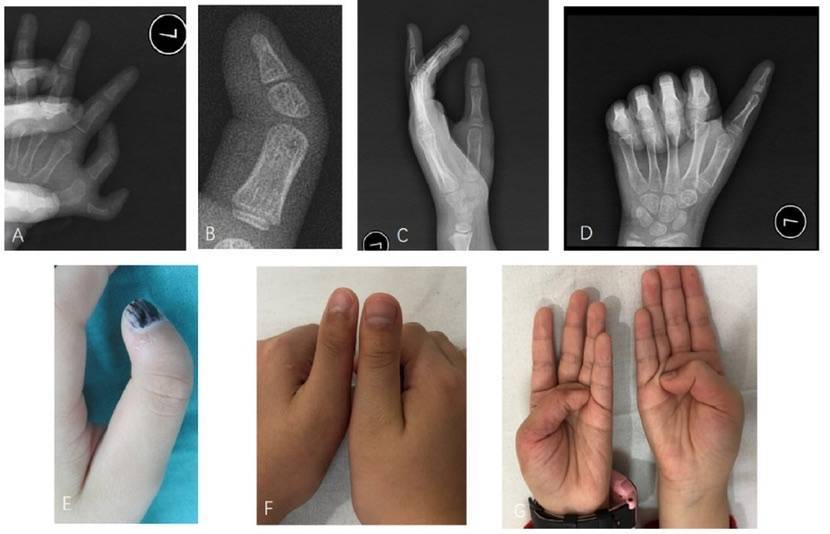 上海儿童医学中心自创拇指尺偏畸形新型手术矫正方法