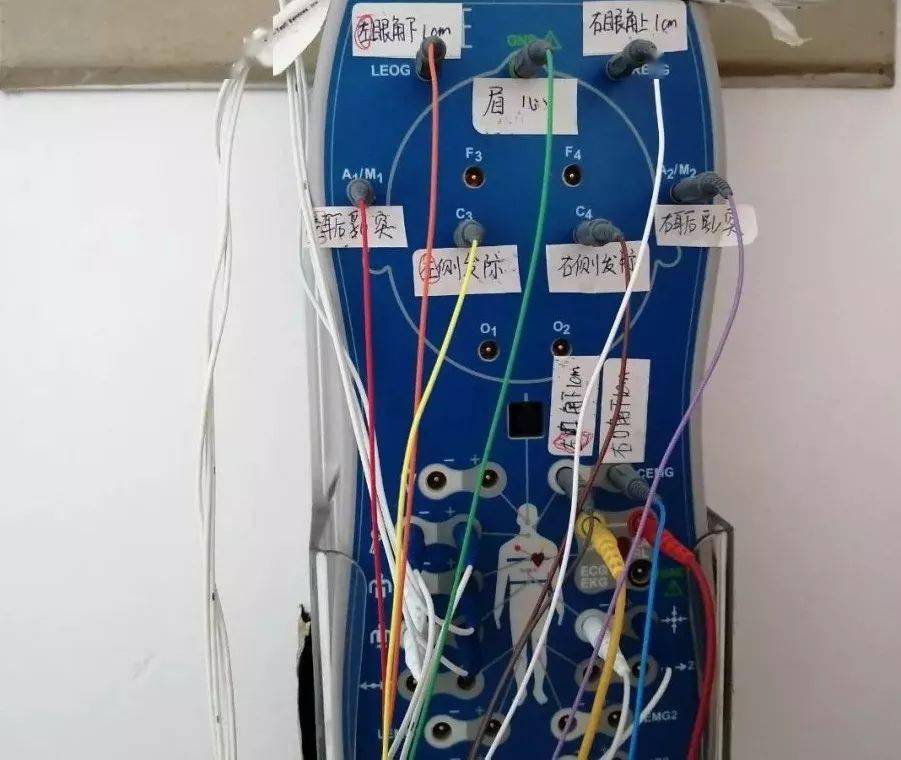 多導睡眠監測儀在患者入睡的狀態下,記錄睡眠時的腦電圖,心電圖,肌電