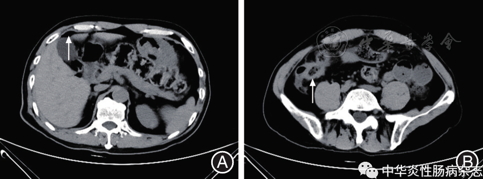 肠穿孔CT图片