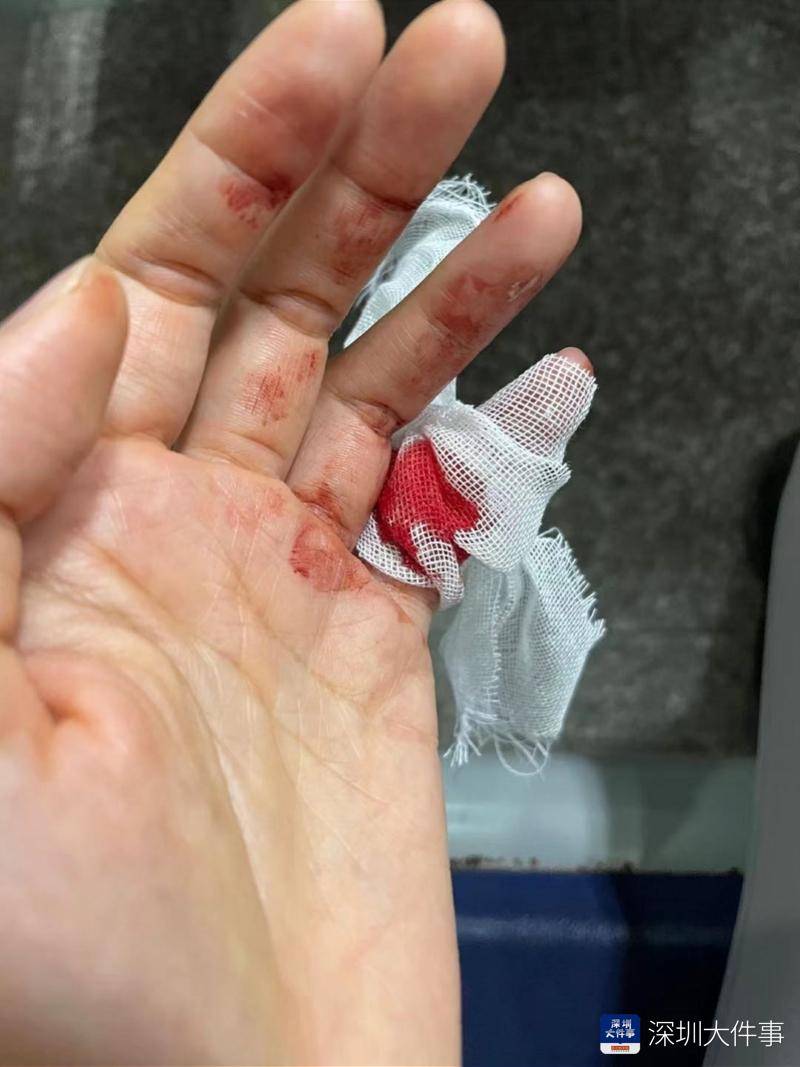 深圳女子在私教指导时被杠铃砸中手指骨折 健身房 教练失误 女士