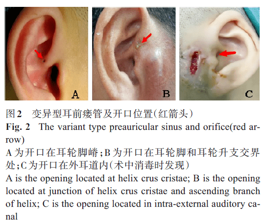 耳前瘘管结构图图片