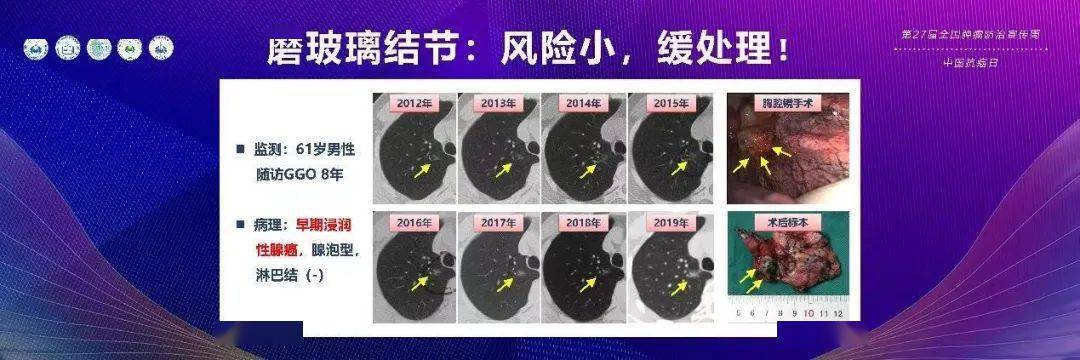 磨玻璃結節要不要手術?王俊院士:胸腔鏡切除是早期肺癌首選手術方式