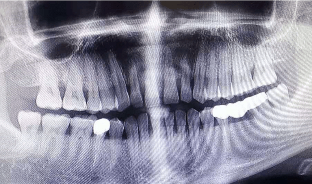 慢性牙周炎患者牙周序列治疗联合修复治疗1例_检查