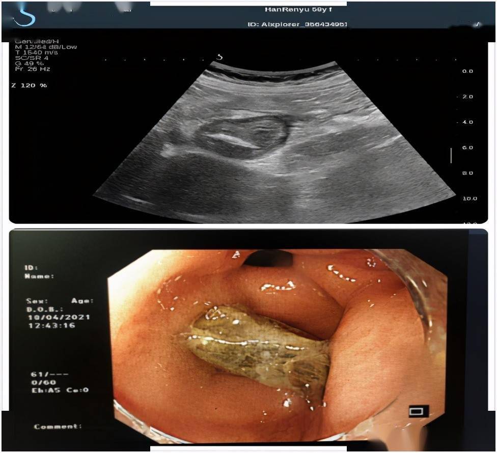韩女士的胃肠超声和胃镜检查显示有枣核嵌顿 通讯员 谯玲玲 胡厚喆
