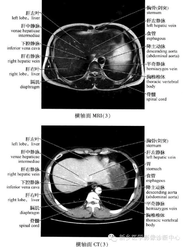 史上最全腹部横断位解剖详细标注