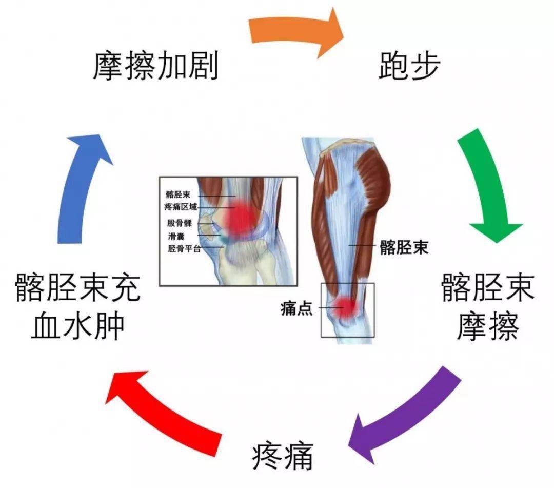 跑马拉松姿势不正确,小心膝盖疼,足底疼,膝关节炎症,踝关节扭伤……找