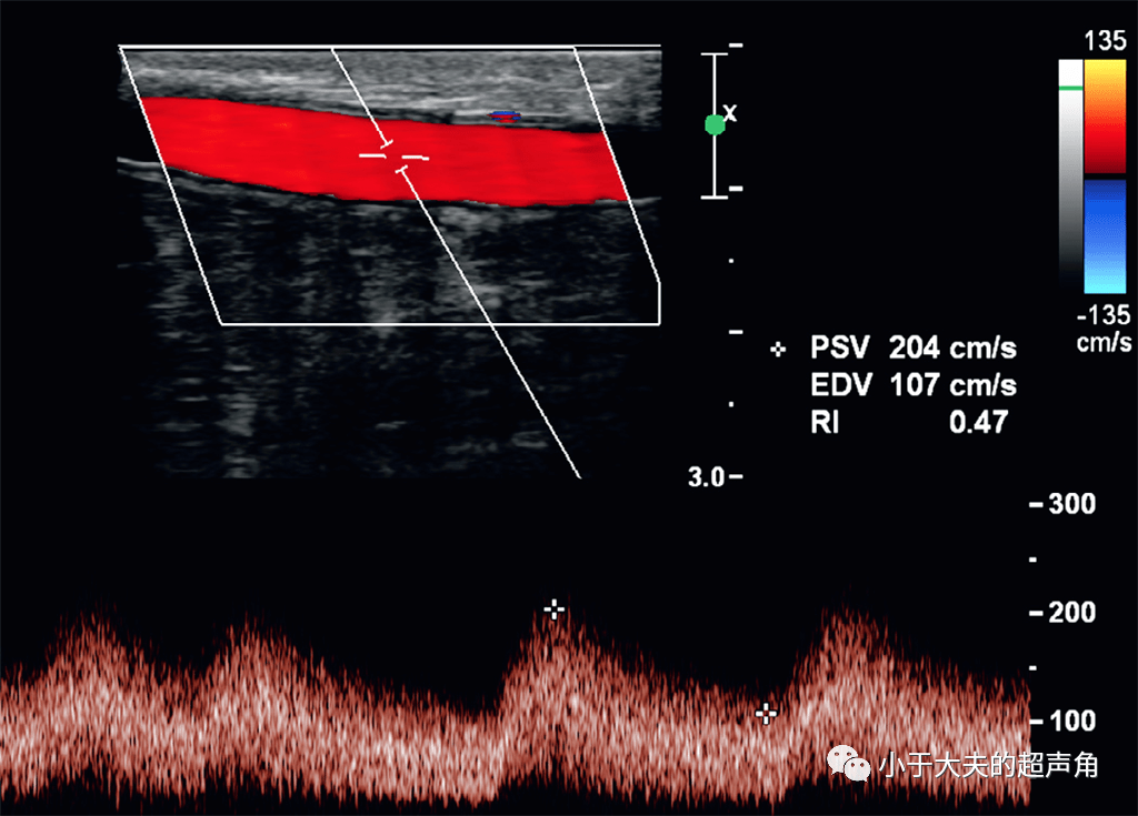 该如何用超声来评估动静脉瘘呢它能造瘘吗它成熟了吗它有狭窄吗