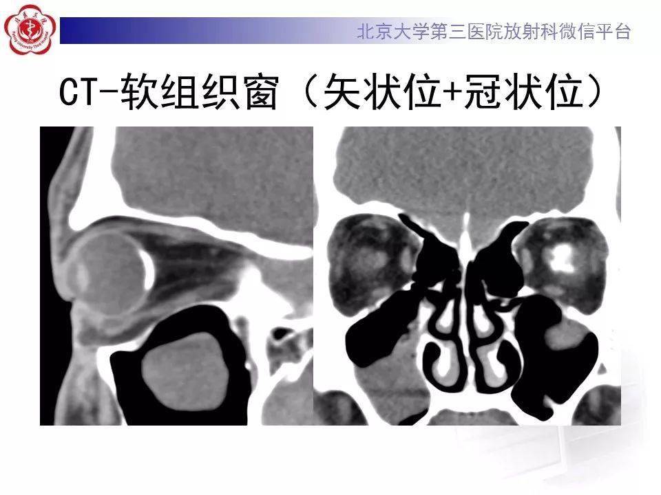 一看就会脉络膜骨瘤影像表现