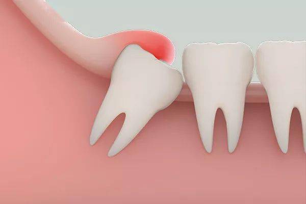 智齒冠周炎(pericoronitis of wisdom teeth,pwt)現也稱第三磨牙