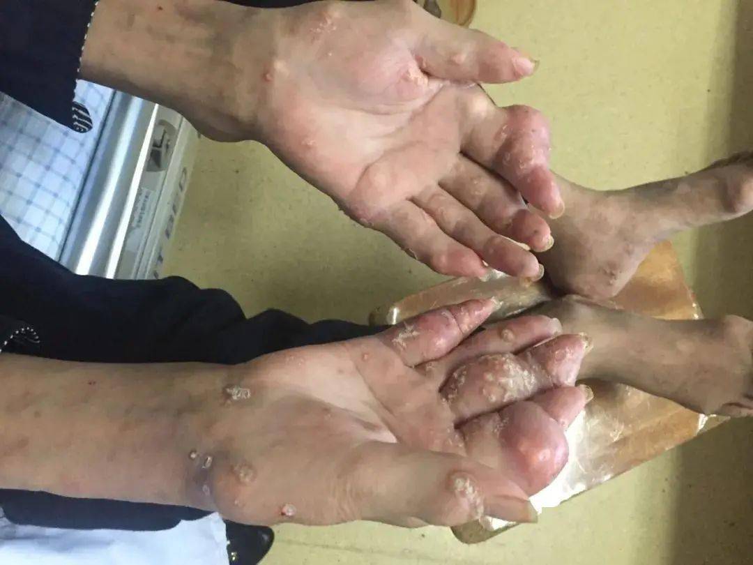 吓人小伙手脚密密麻麻长满石头医生叹息这习惯很多人都有