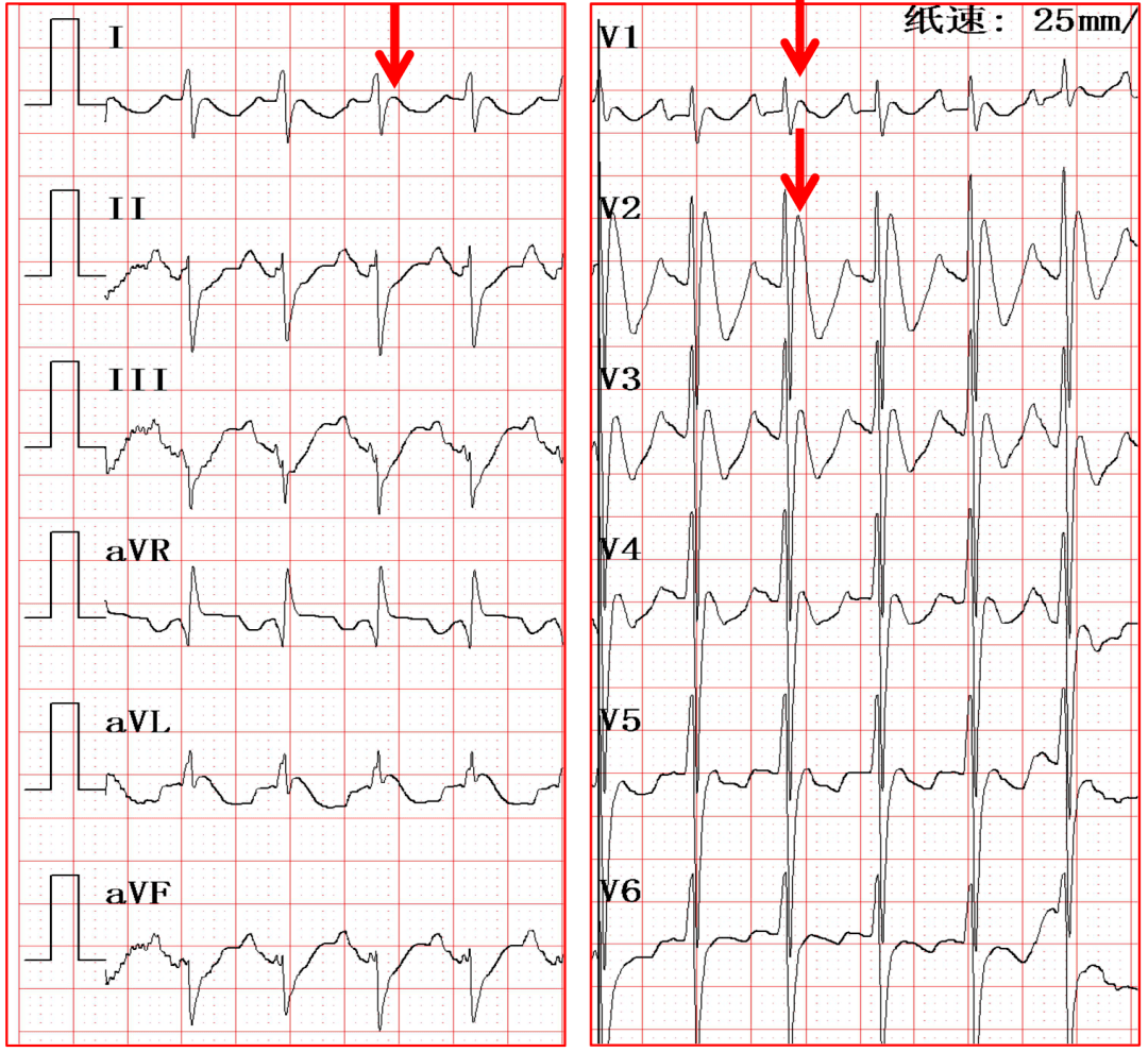 有关 右束支阻滞 的4 问4 答 附典型心电图 基础篇 右室
