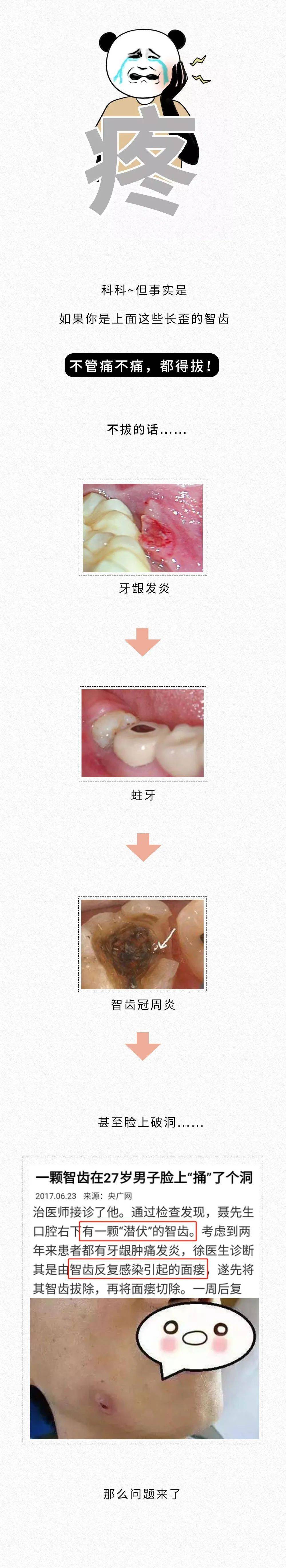 智齒忍著不拔,臉上會爛出個洞?_牙齒