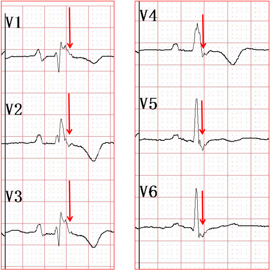 ② qrs 终末低幅小棘波,为心室晚电位,以右胸导联明显