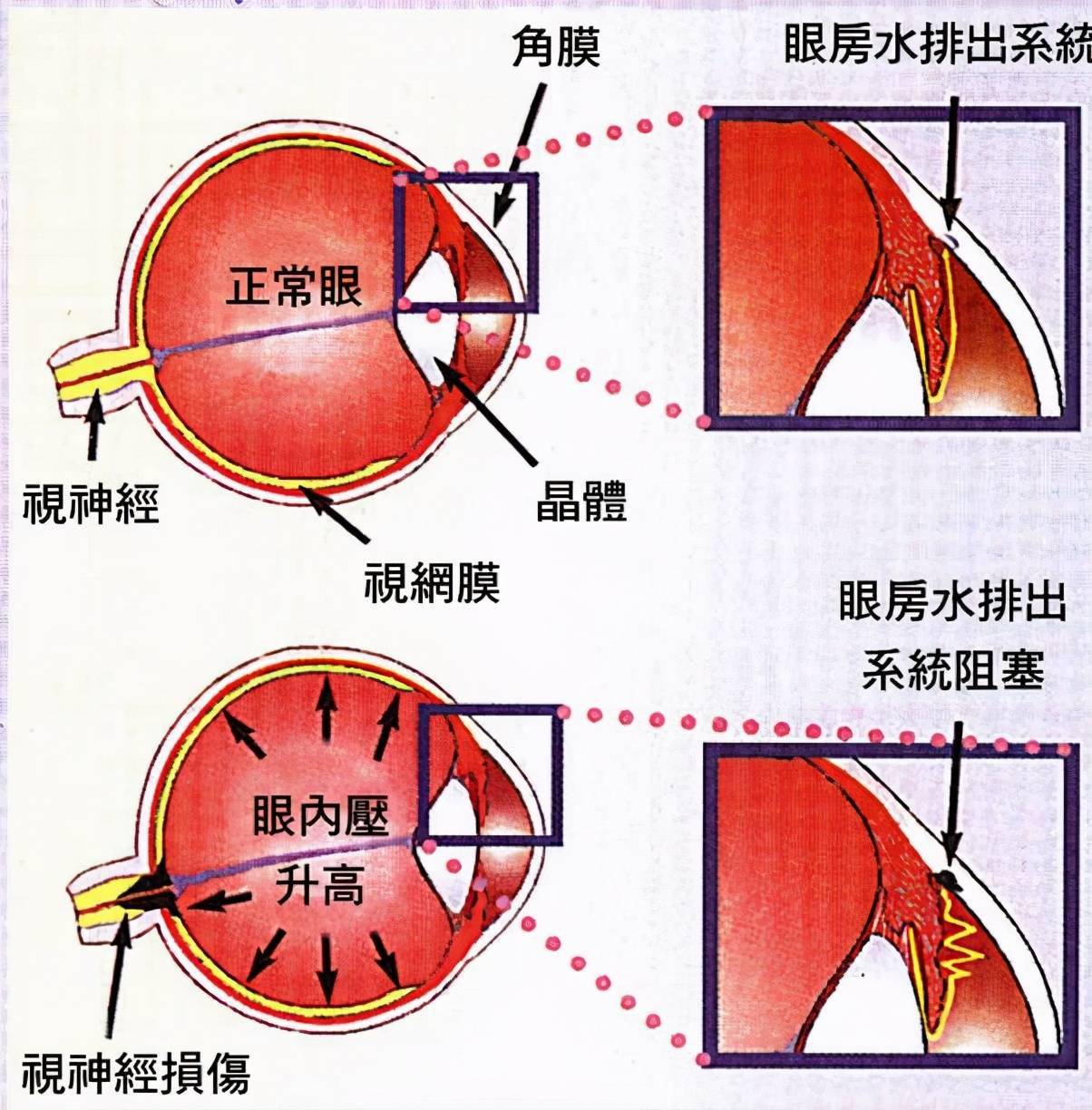 想用降眼壓的眼藥水來增長睫毛建議你先看看這篇文章