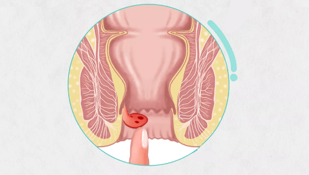 疾病科普丨发生内痔脱出时，你最应该做的几件事_肛门