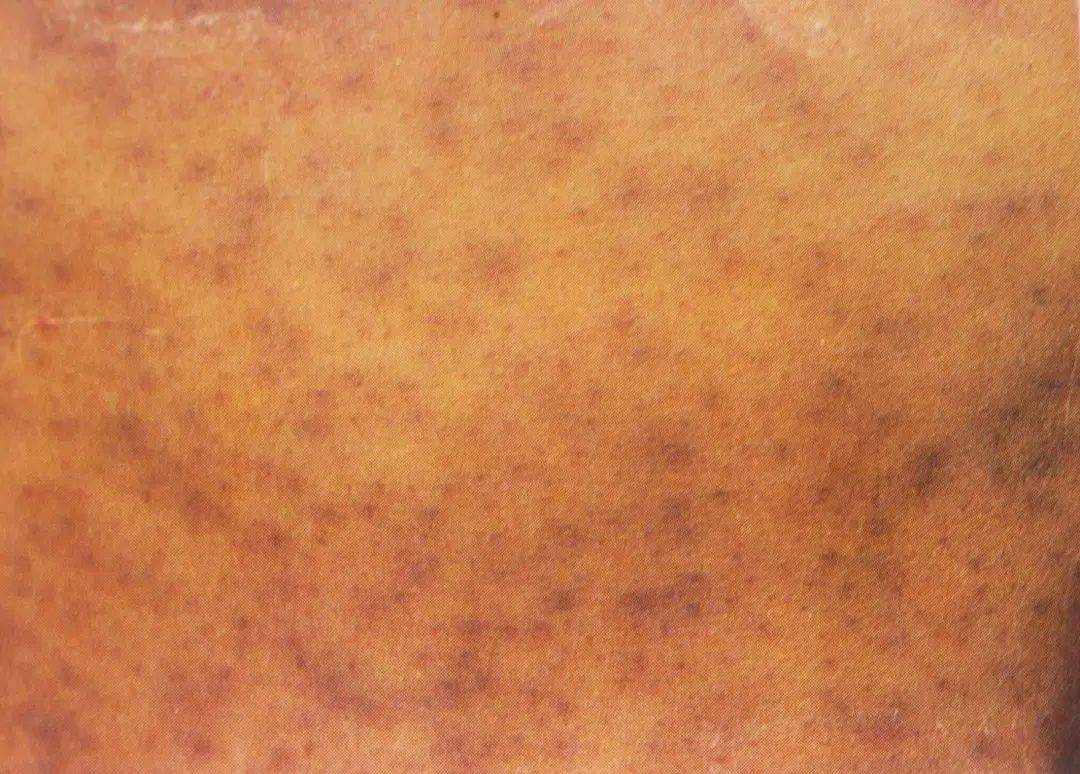 职业病防治法宣传周职业性皮肤病