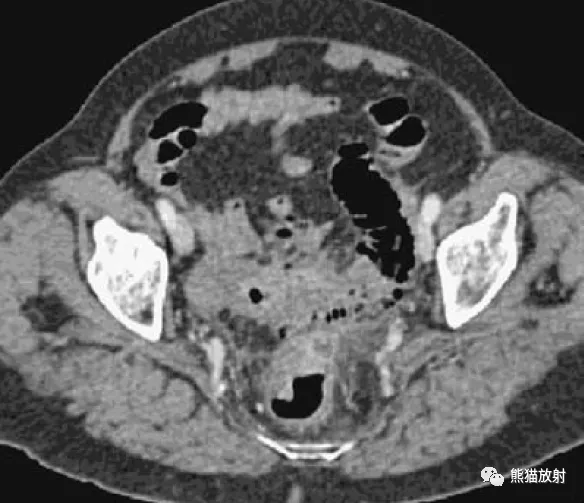 腹部影像图例结直肠篇