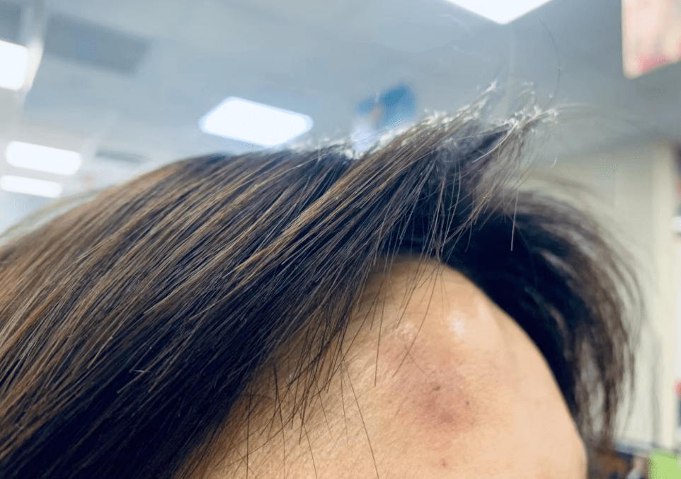 飞来横祸!道路指示牌突然倒地 朝青一女子被砸进医院