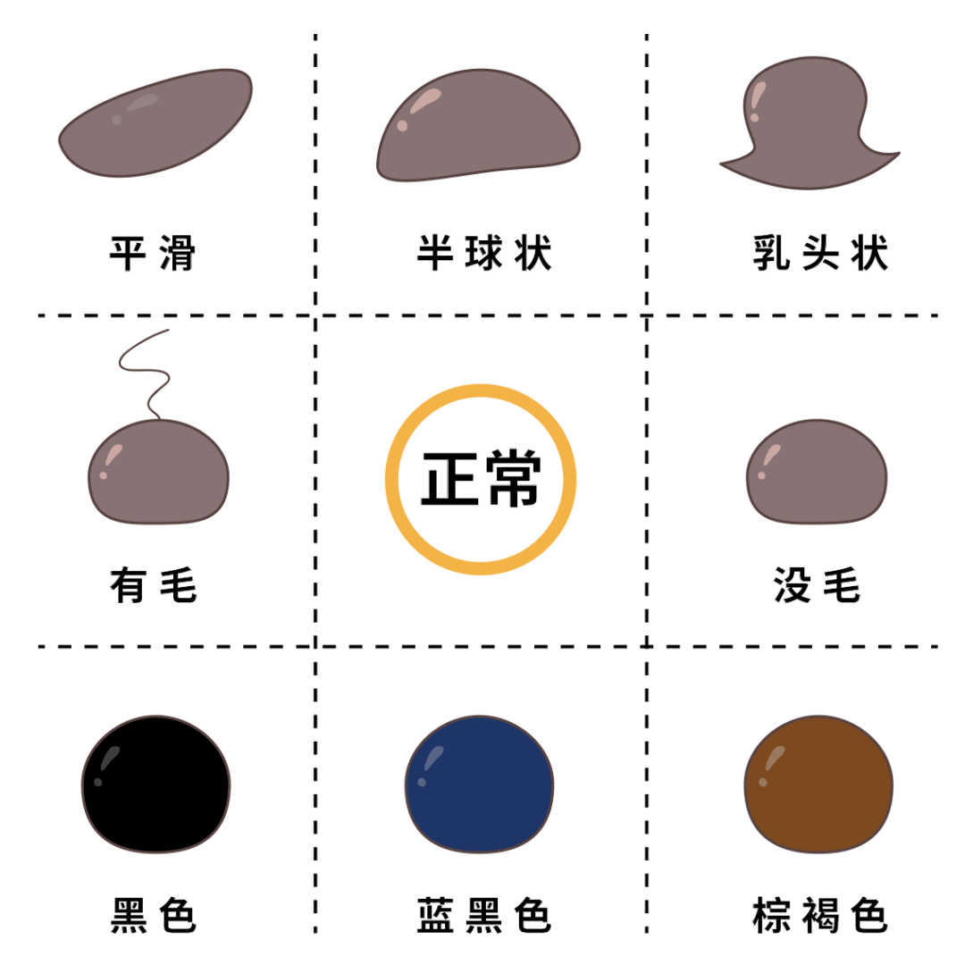 痣也可能会癌变!长在 3 个地方要注意